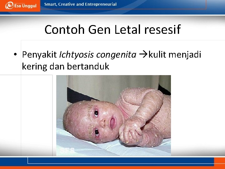 Contoh Gen Letal resesif • Penyakit Ichtyosis congenita kulit menjadi kering dan bertanduk 