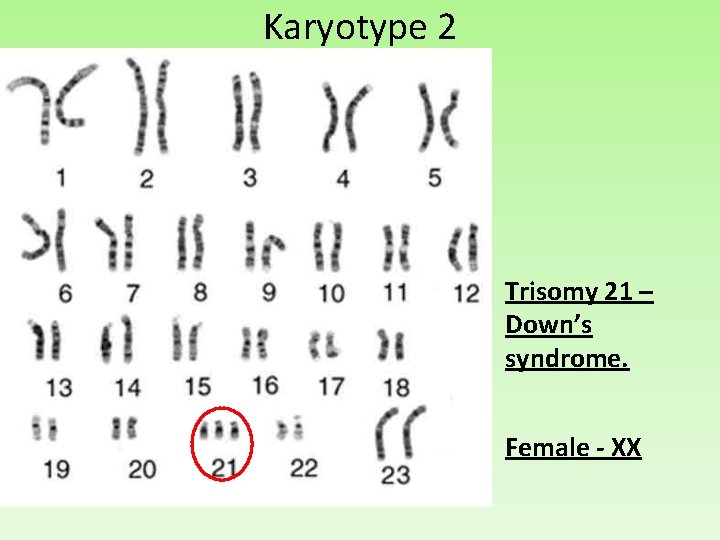 Karyotype 2 Trisomy 21 – Down’s syndrome. Female - XX 