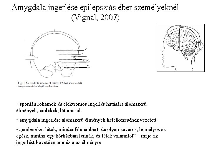Amygdala ingerlése epilepsziás éber személyeknél (Vignal, 2007) • spontán rohamok és elektromos ingerlés hatására