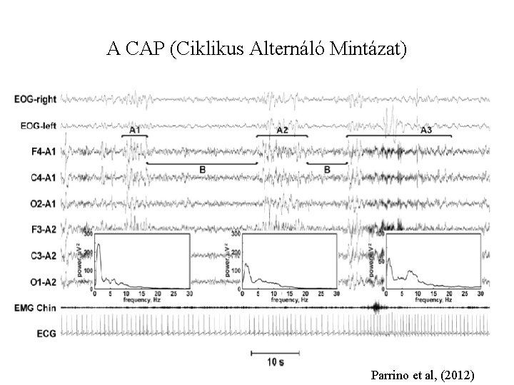 A CAP (Ciklikus Alternáló Mintázat) Parrino et al, (2012) 