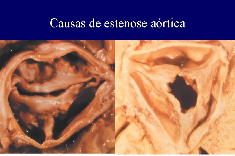Causas de estenose aórtica Causas de estenose aórtica