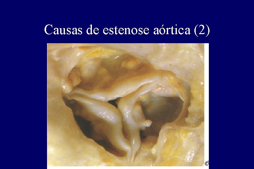Causas de estenose aórtica (2) Causas de estenose aórtica (2)