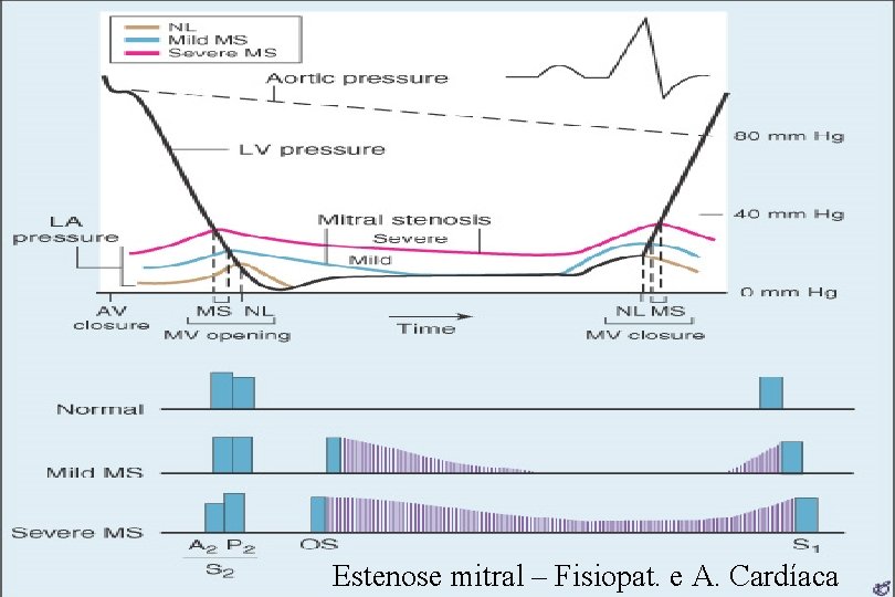 Estenose mitral – Fisiopat. e A. Cardíaca Estenose mitral – Fisiopat. e A. Cardíaca