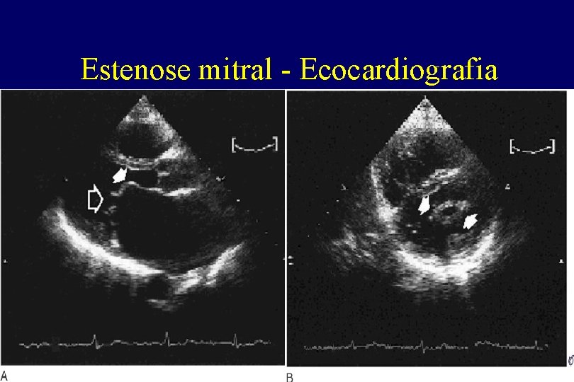 Estenose mitral - Ecocardiografia Estenose mitral - Ecocardiografia