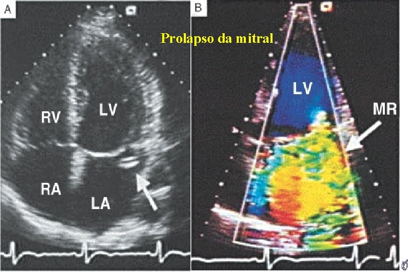 Prolapso da mitral Prolapso da mitral