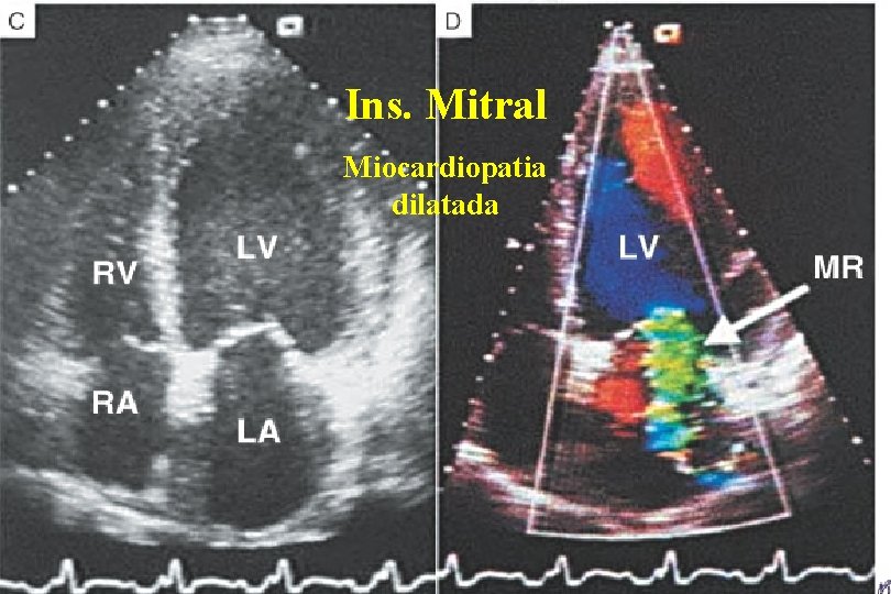 Ins. Mitral Miocardiopatia dilatada Ins. Mitral Miocardiopatia dilatada