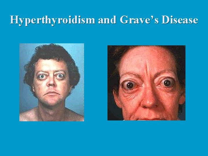Hyperthyroidism and Grave’s Disease 