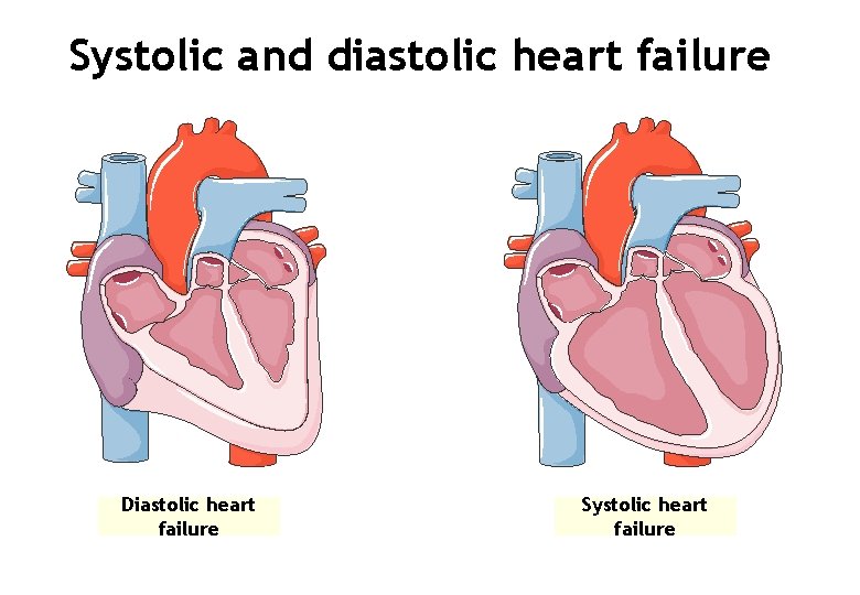 Systolic and diastolic heart failure Diastolic heart failure Systolic heart failure 
