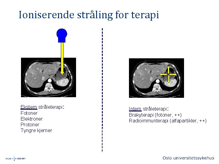 Ioniserende stråling for terapi Ekstern stråleterapi: Fotoner Elektroner Protoner Tyngre kjerner Intern stråleterapi: Brakyterapi