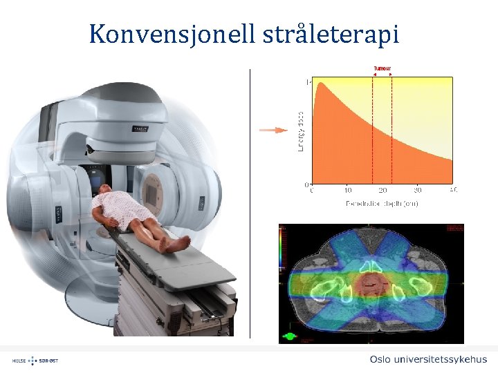 Konvensjonell stråleterapi 