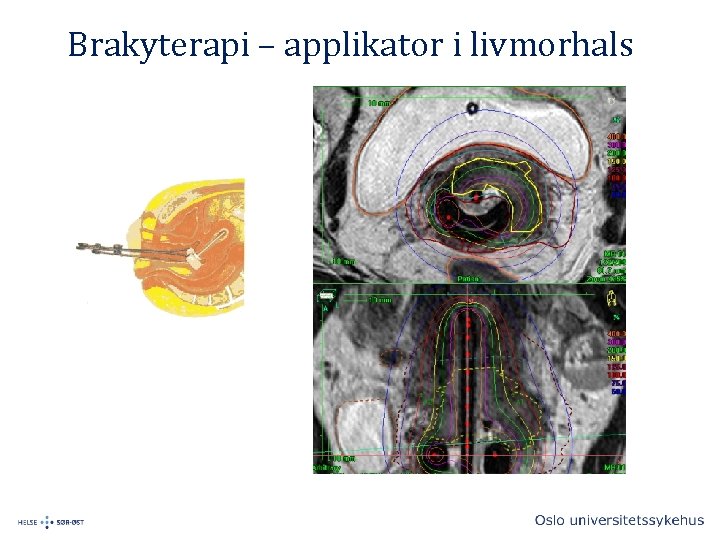 Brakyterapi – applikator i livmorhals 