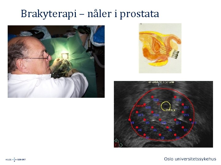 Brakyterapi – nåler i prostata 