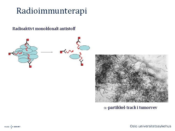 Radioimmunterapi Radioaktivt monoklonalt antistoff a-partikkel-track i tumorvev 