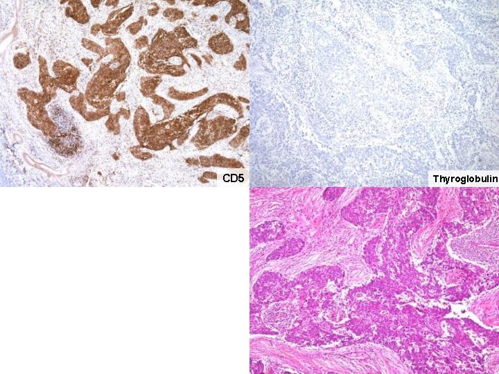 CD 5 Thyroglobulin CD 5 Thyroglobulin