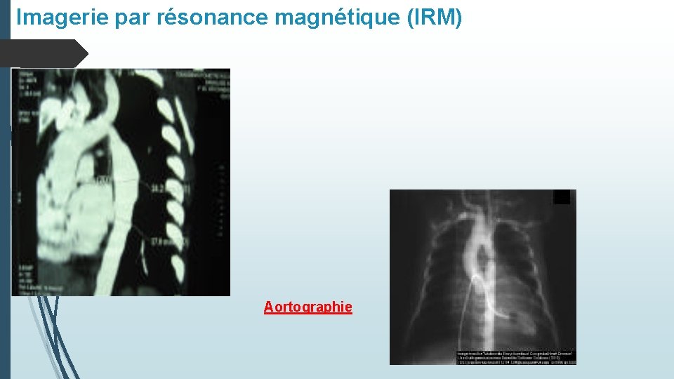 Imagerie par résonance magnétique (IRM) Aortographie 