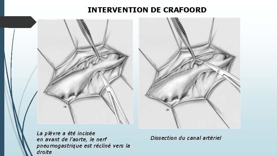 INTERVENTION DE CRAFOORD La plèvre a été incisée en avant de l’aorte, le nerf