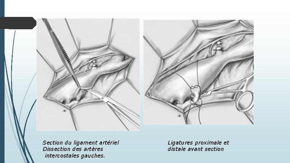 Section du ligament artériel Dissection des artères intercostales gauches. Ligatures proximale et distale avant