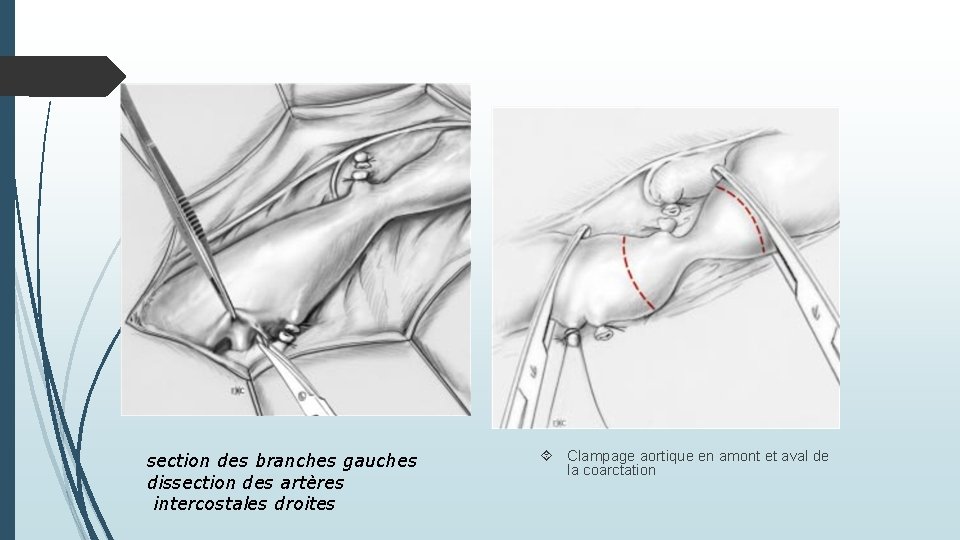 section des branches gauches dissection des artères intercostales droites Clampage aortique en amont et
