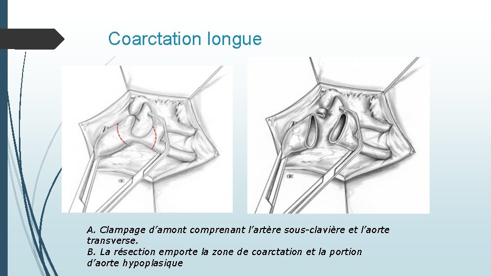 Coarctation longue A. Clampage d’amont comprenant l’artère sous-clavière et l’aorte transverse. B. La résection