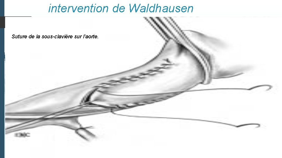 intervention de Waldhausen Clampage de l’aorte transverse entre la sous-clavière et la Le lambeau