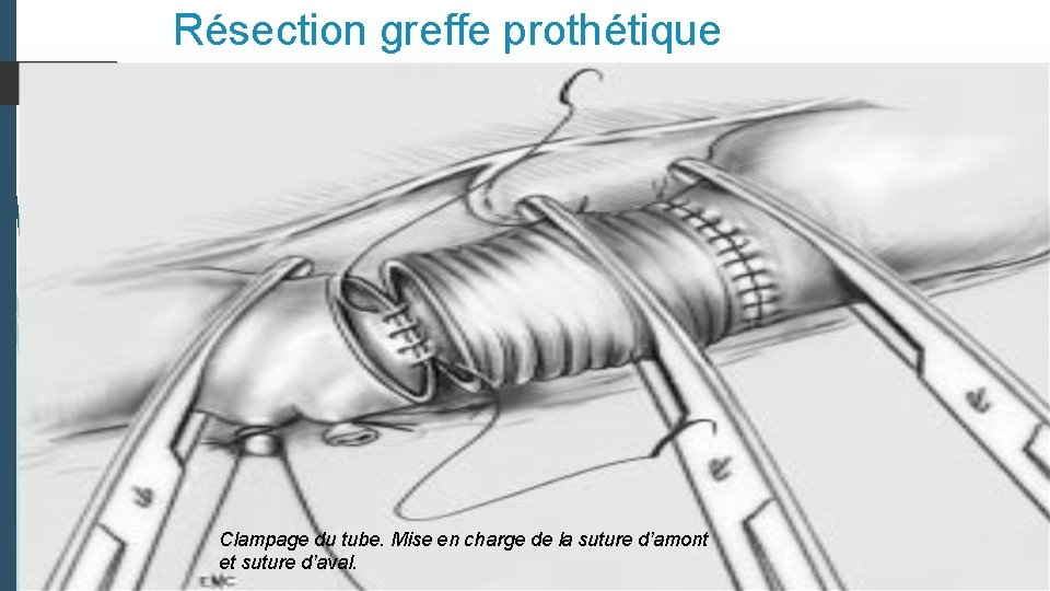 Résection greffe prothétique tube d’amont par Clampage du tube. Suture Mise end’un charge determinoterminal.