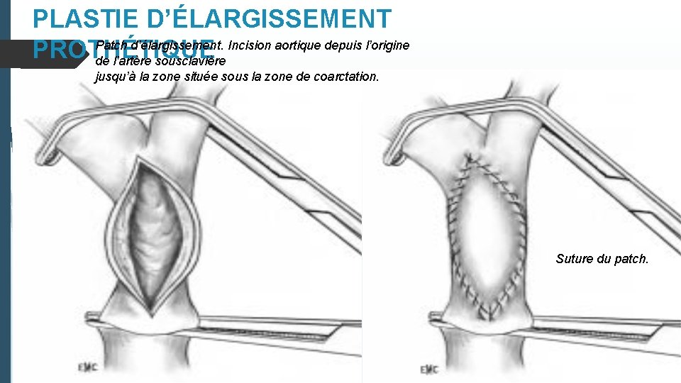 PLASTIE D’ÉLARGISSEMENT Patch d’élargissement. Incision aortique depuis l’origine PROTHÉTIQUE de l’artère sousclavière jusqu’à la