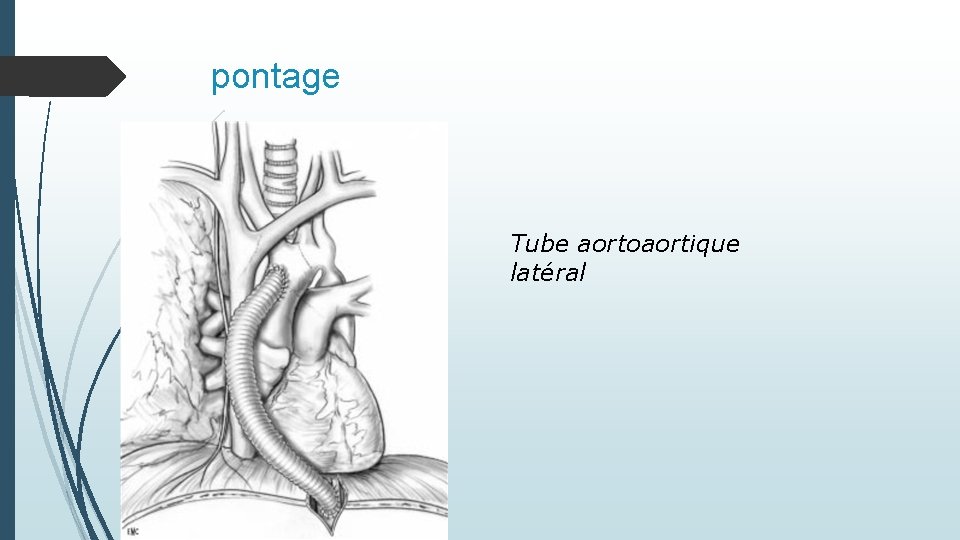 pontage Tube aortoaortique latéral 