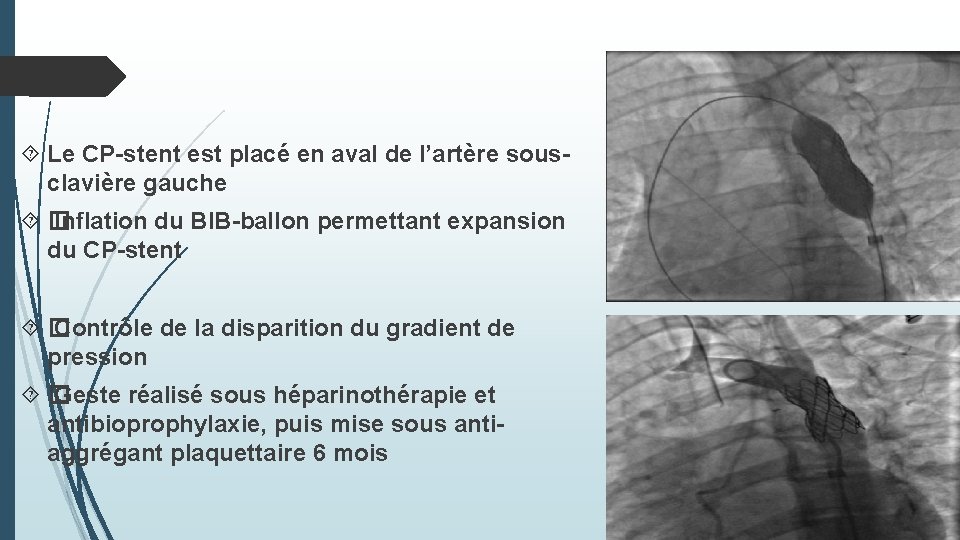  Le CP-stent est placé en aval de l’artère sousclavière gauche � Inflation du