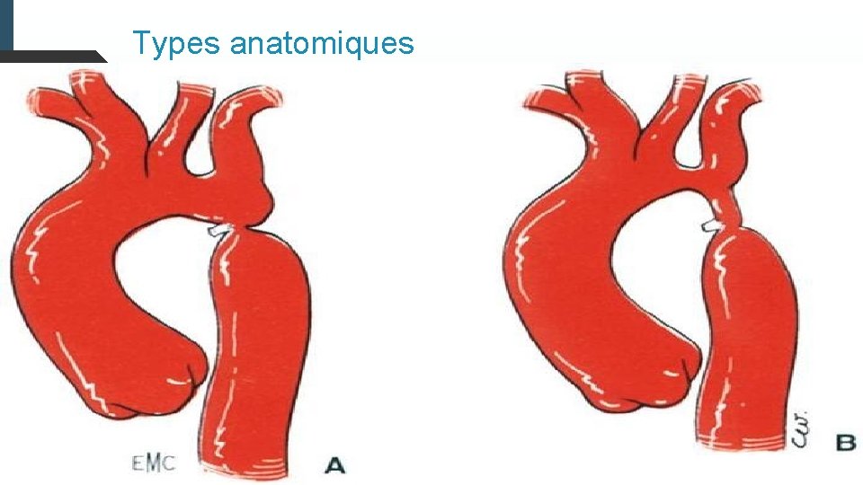 Types anatomiques Sténose courte: en diaphragme 80 à 90%des cas. Sténose longue: hypoplasie tubulaire