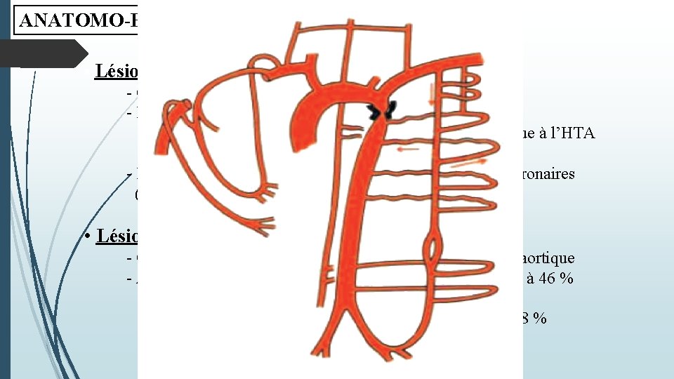 ANATOMO-PATHOLOGIE • Lésions induites par la coarctation - Circulation collatérale - Formation d’anévrysme (10