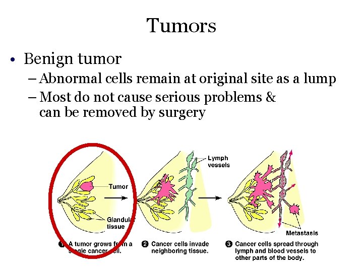 Tumors • Benign tumor – Abnormal cells remain at original site as a lump