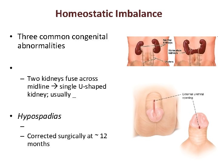 Homeostatic Imbalance • Three common congenital abnormalities • – Two kidneys fuse across midline