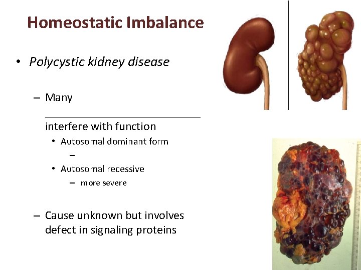 Homeostatic Imbalance • Polycystic kidney disease – Many _____________ interfere with function • Autosomal