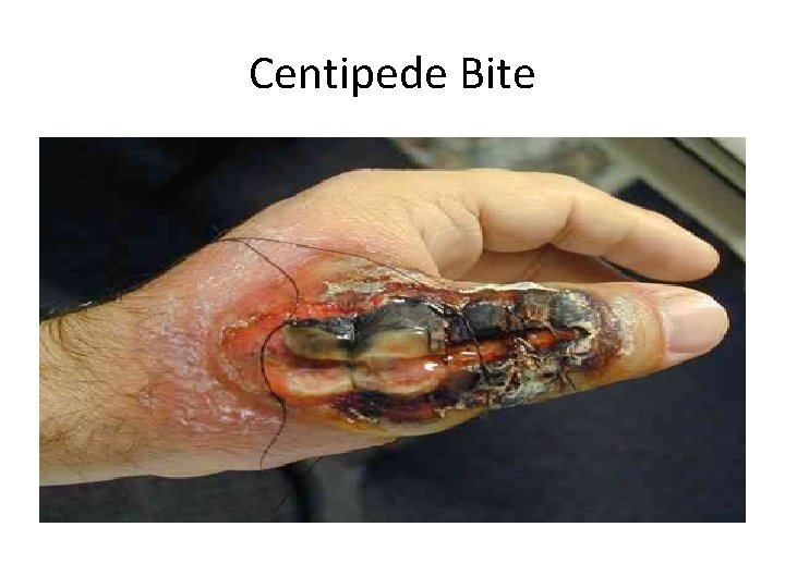 Centipede Bite 