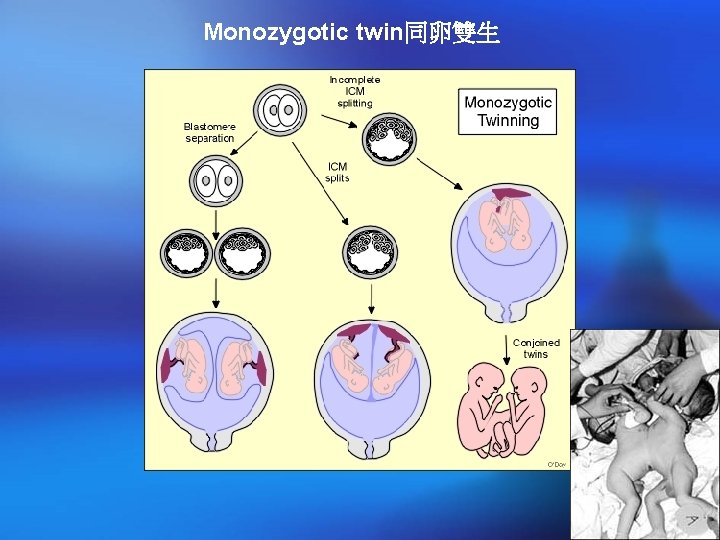 Monozygotic twin同卵雙生 