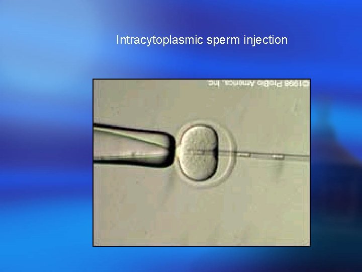Intracytoplasmic sperm injection 