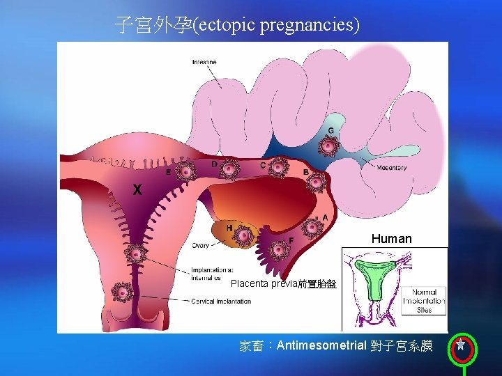子宮外孕(ectopic pregnancies) Human Placenta previa前置胎盤 家畜：Antimesometrial 對子宮系膜 