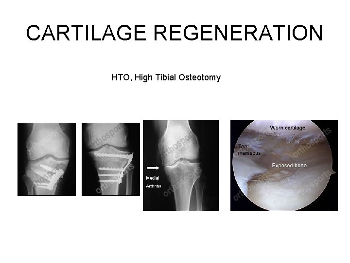 CARTILAGE REGENERATION HTO, High Tibial Osteotomy 