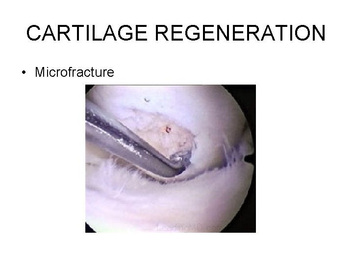 CARTILAGE REGENERATION • Microfracture 