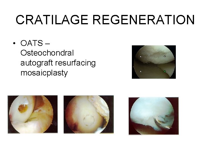 CRATILAGE REGENERATION • OATS – Osteochondral autograft resurfacing mosaicplasty CRATILAGE REGENERATION • OATS – Osteochondral autograft resurfacing mosaicplasty