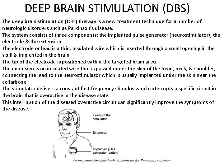 DEEP BRAIN STIMULATION (DBS) The deep brain stimulation (DBS) therapy is a new treatment