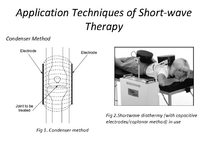 Application Techniques of Short-wave Therapy Condenser Method Fig 2. Shortwave diathermy (with capacitive electrodes/coplanar