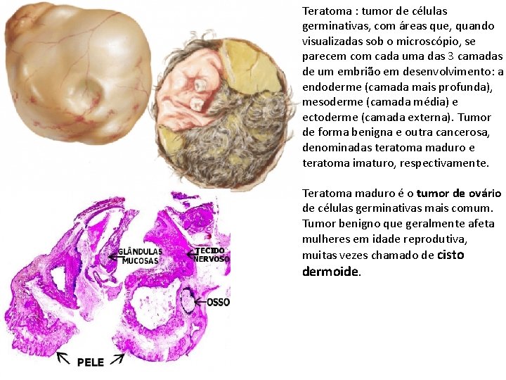 Teratoma : tumor de células germinativas, com áreas que, quando visualizadas sob o microscópio,
