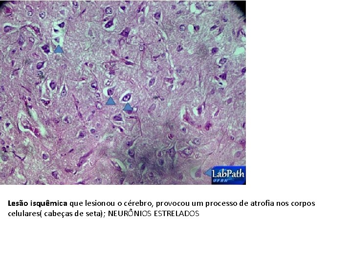 Lesão isquêmica que lesionou o cérebro, provocou um processo de atrofia nos corpos celulares(