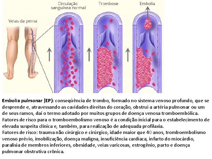 Embolia pulmonar (EP): conseqüência de trombo, formado no sistema venoso profundo, que se desprende