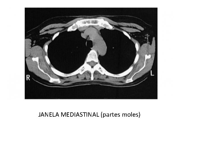 JANELA MEDIASTINAL (partes moles) 