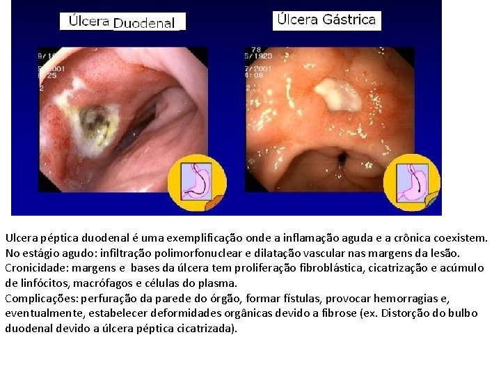 Ulcera péptica duodenal é uma exemplificação onde a inflamação aguda e a crônica coexistem.