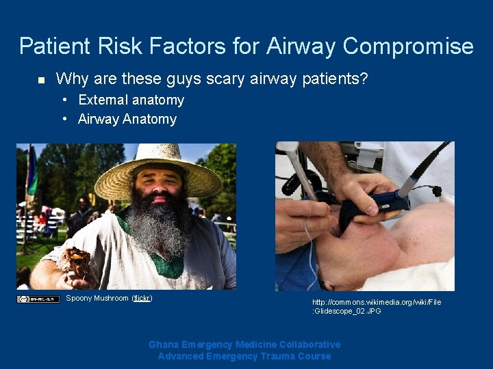 Patient Risk Factors for Airway Compromise n Why are these guys scary airway patients? Patient Risk Factors for Airway Compromise n Why are these guys scary airway patients?
