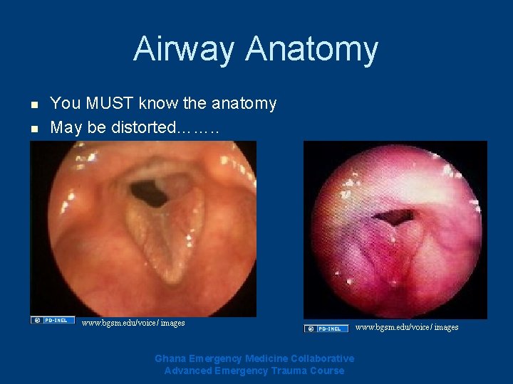 Airway Anatomy n n You MUST know the anatomy May be distorted……. . www. Airway Anatomy n n You MUST know the anatomy May be distorted……. . www.