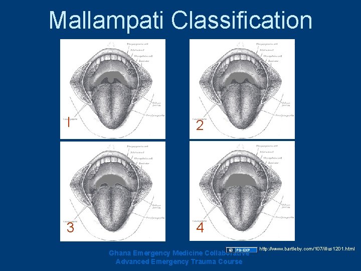 Mallampati Classification I 2 3 4 Ghana Emergency Medicine Collaborative Advanced Emergency Trauma Course Mallampati Classification I 2 3 4 Ghana Emergency Medicine Collaborative Advanced Emergency Trauma Course